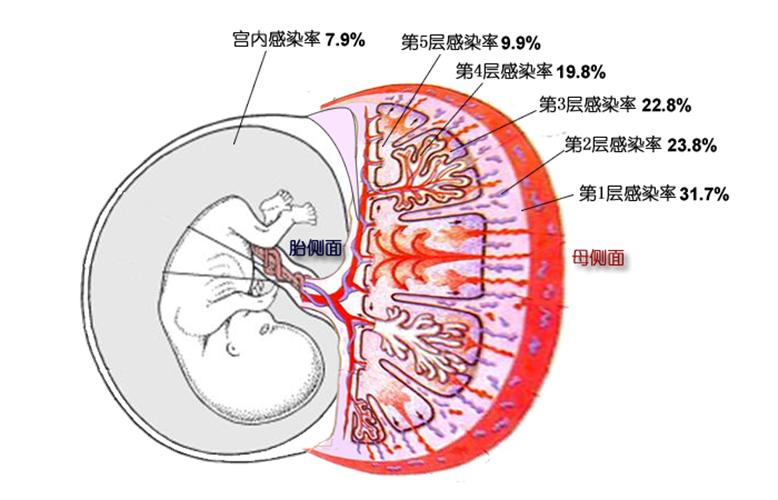 妊娠合并梅毒的胎盘图片
