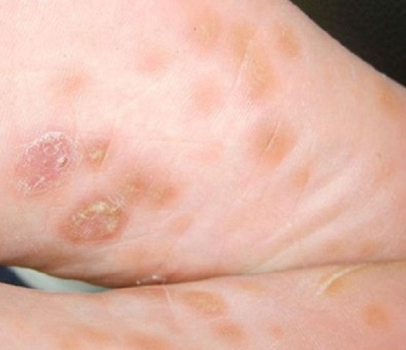 妊娠合并梅毒脚部症状的图片