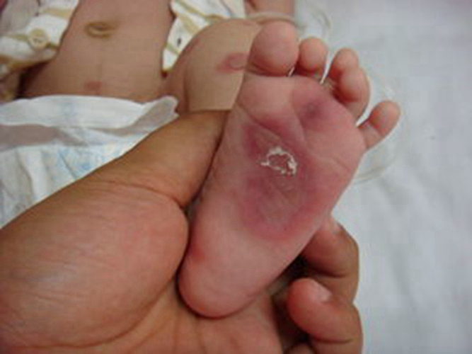 婴儿梅毒疹子图片图片