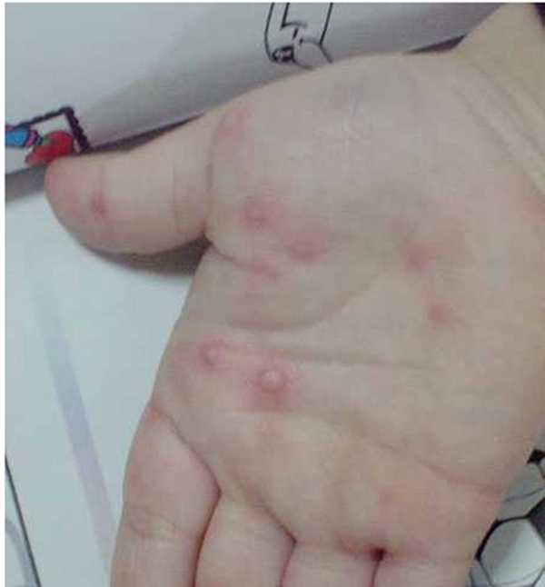 手足口病中期图片图片