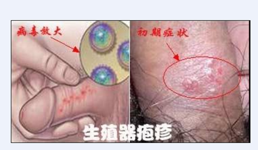 男性早期生殖器疱疹症状图片