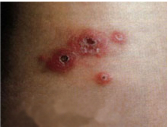 生殖器疱疹啥症状图片
