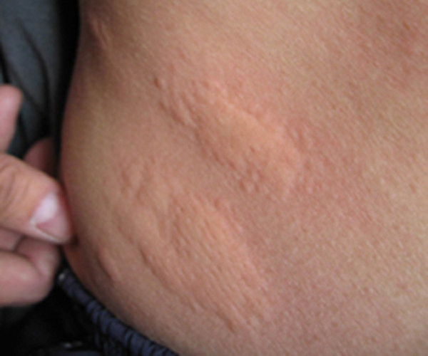 划痕性荨麻疹的症状图片