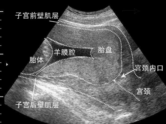 妊娠合并梅毒的诊断图片