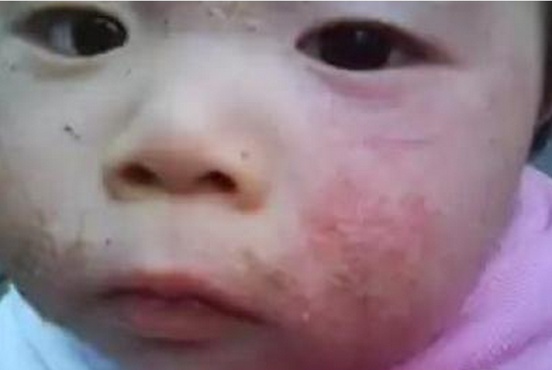 婴儿脸上小儿湿疹结痂图片