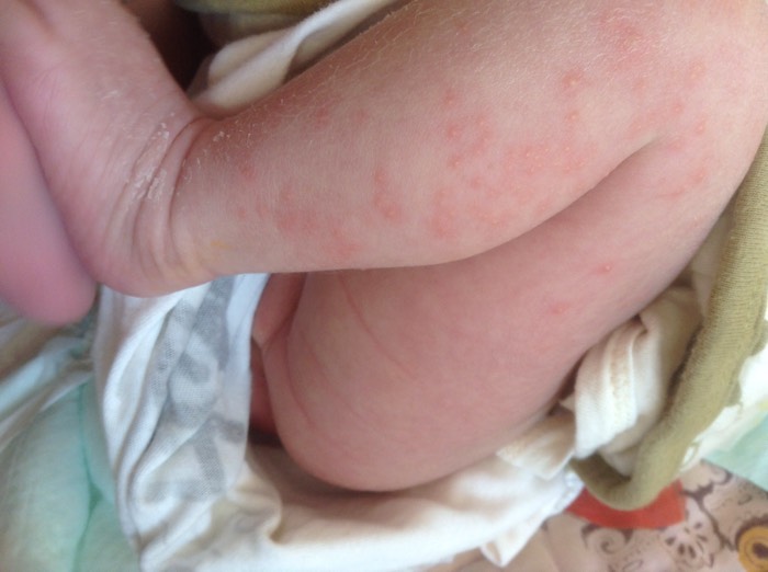 婴儿湿疹的发病原因很多,由于体内湿热过重,食物过敏,室内空气污染