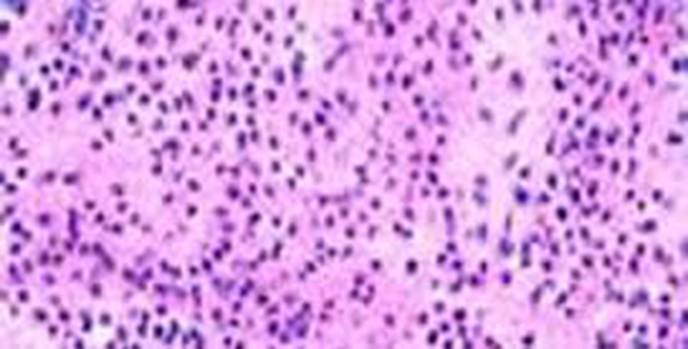  夏季皮炎细胞图片