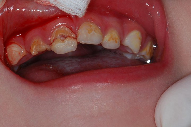 侧切牙蛀牙图片