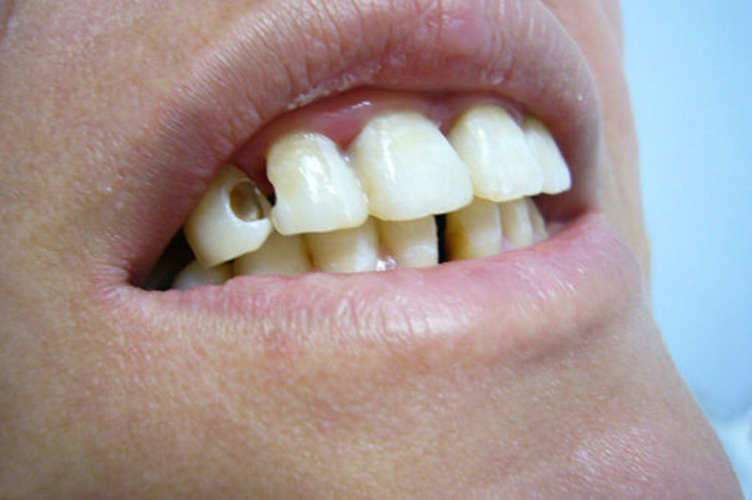 前牙龋齿图片