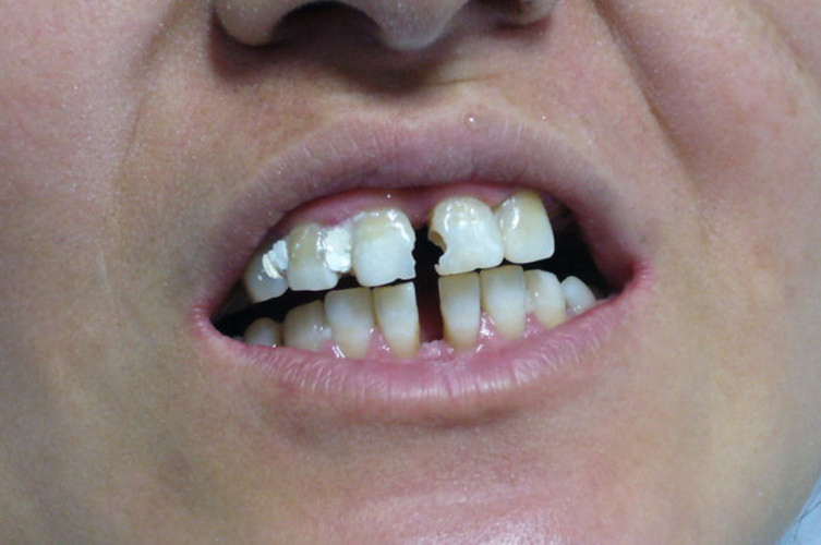 门牙龋齿填充后图图片
