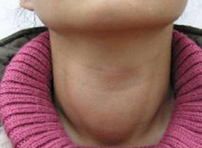典型颈部淋巴结肿大图片