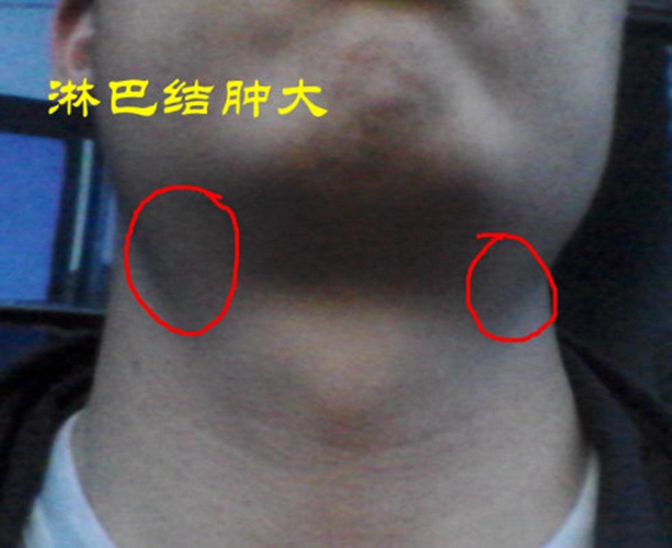 男性颈部双侧淋巴结肿大图片