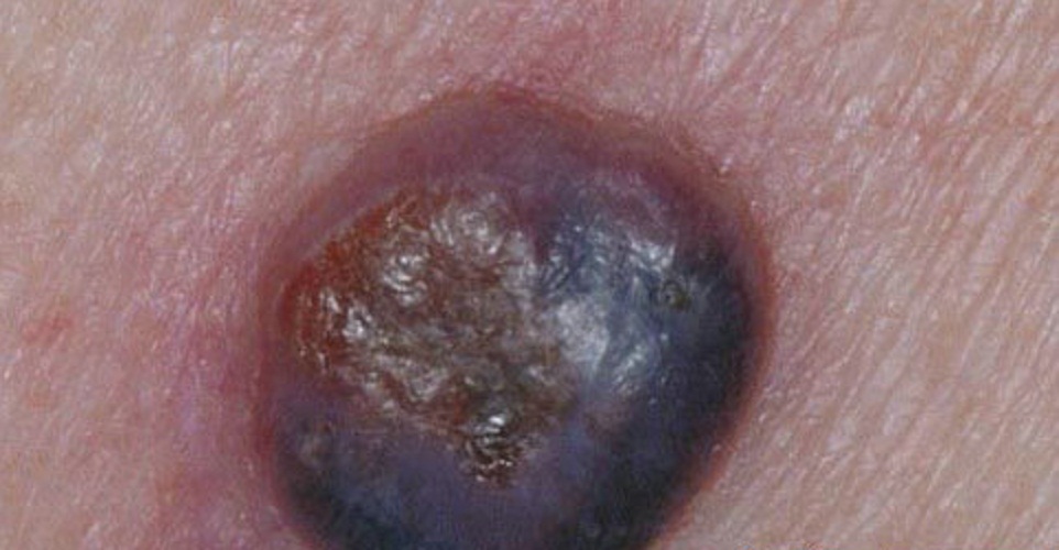 皮肤癌 初期图片