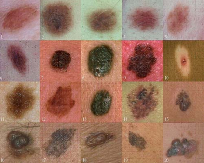 皮肤癌的种类及图片