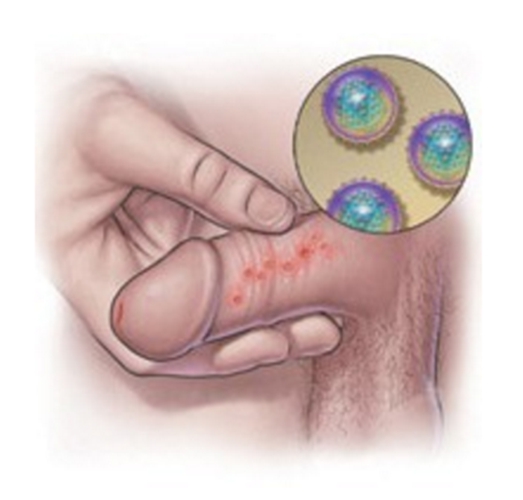 生殖器疱疹早期症状图片