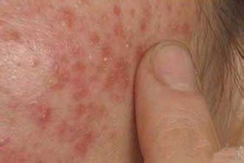 丘疹性痤疮皮损症状图片