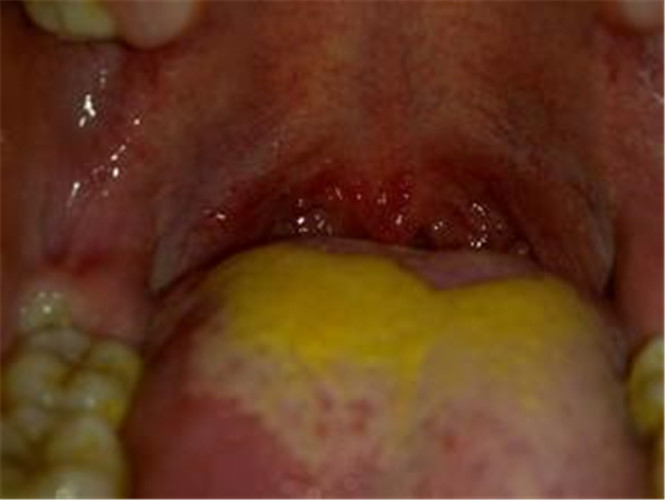 急性扁桃体炎之舌苔异常图片