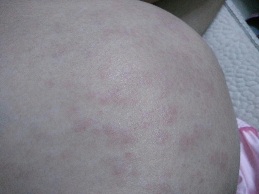 4张高清图片，告诉你湿疹与热疹到底有何区别 - 柚喜