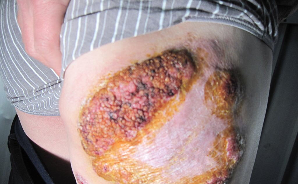大腿外侧的皮肤结核病图片