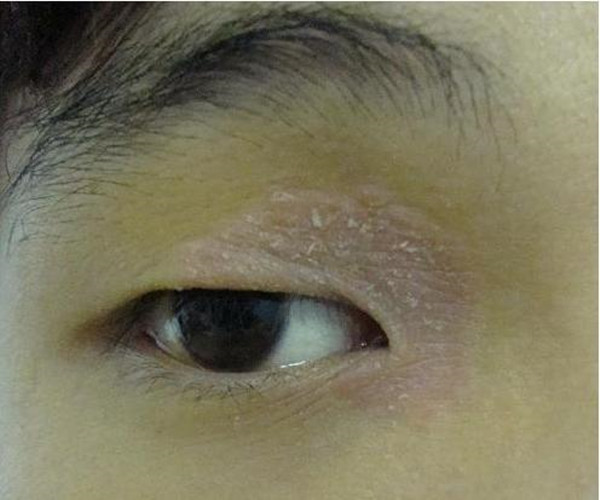 眼部的皮肤结核病图片
