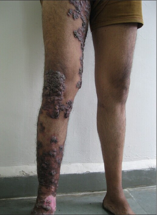 人的双下肢皮肤结核病图片