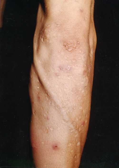 手臂的皮肤结核病症状图片