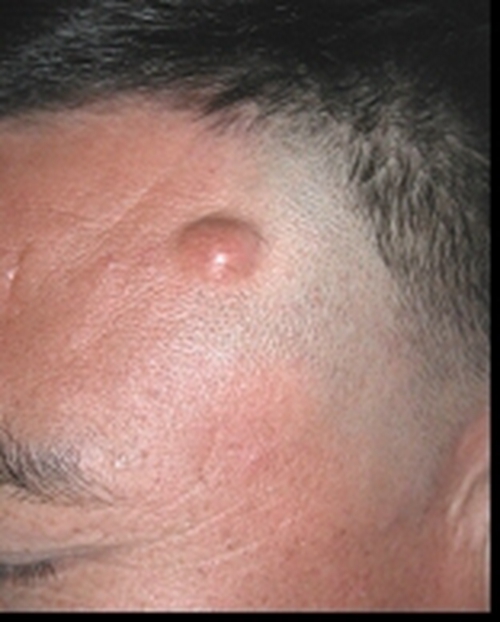 皮肤良性肿瘤早期图片图片
