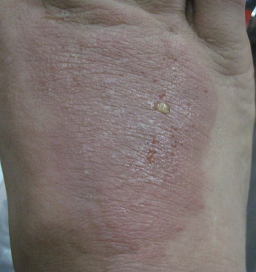 早期皮肤结核病图片