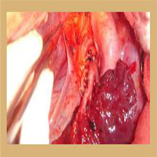 直肠息肉手术过程图片