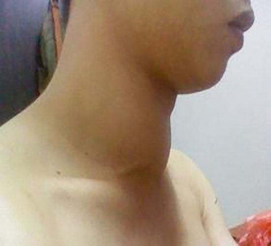 男性甲状腺瘤的早期症状图片