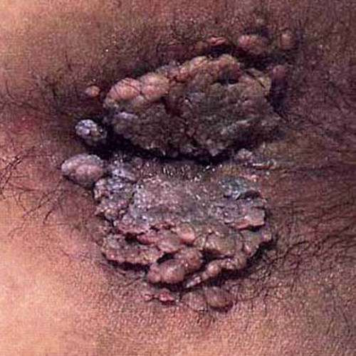 肛门湿疹的危害图片