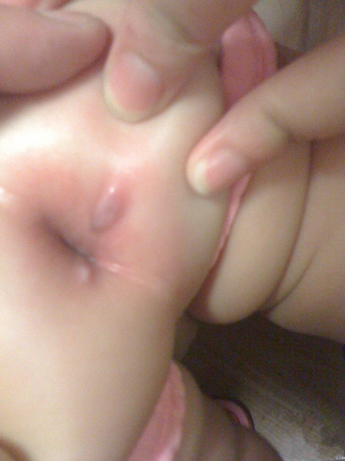 小宝肛门湿疹起小泡图片