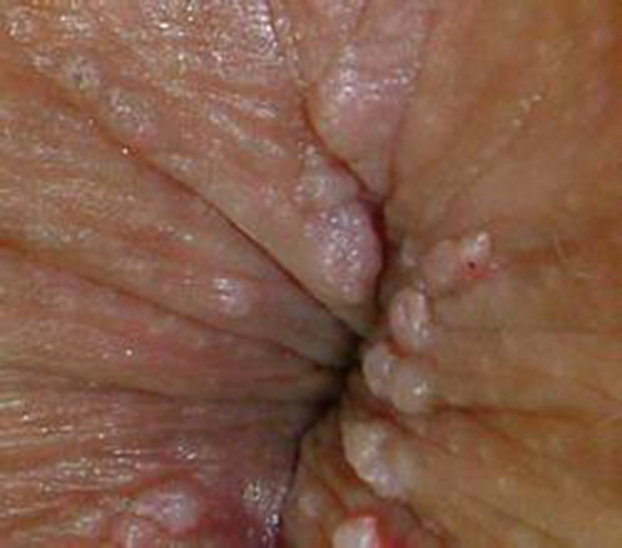 这是肛门湿疹图解图片