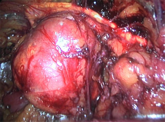 腹腔镜中的肾上腺肿瘤图片
