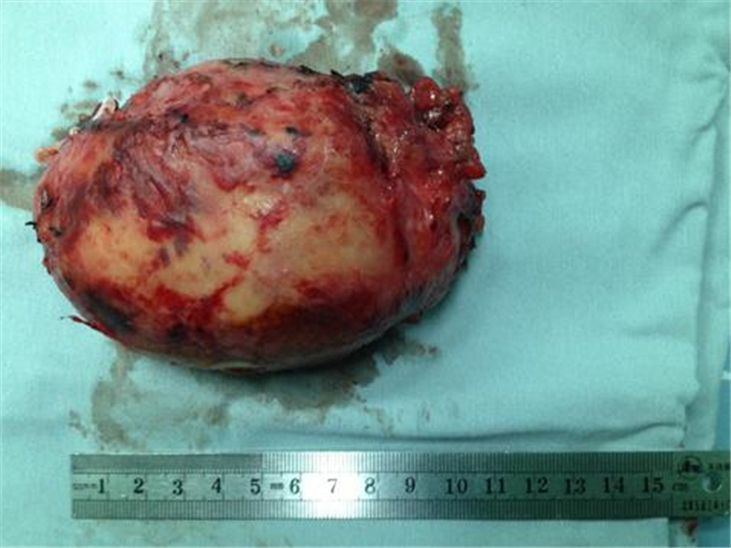 切除的巨大肾上腺肿瘤的图片