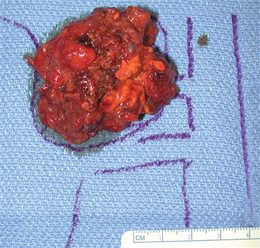 肾上腺肿瘤标本图片