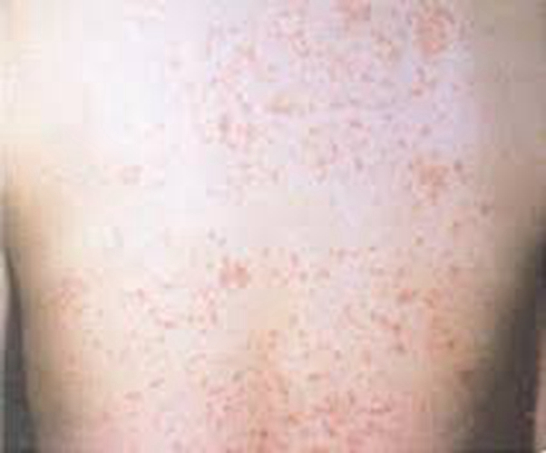  夏季皮炎背部图片
