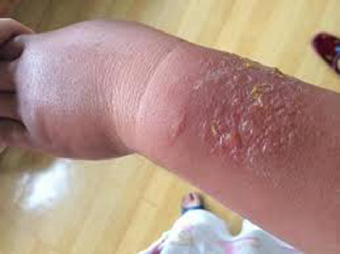  夏季皮炎后疱疹图片