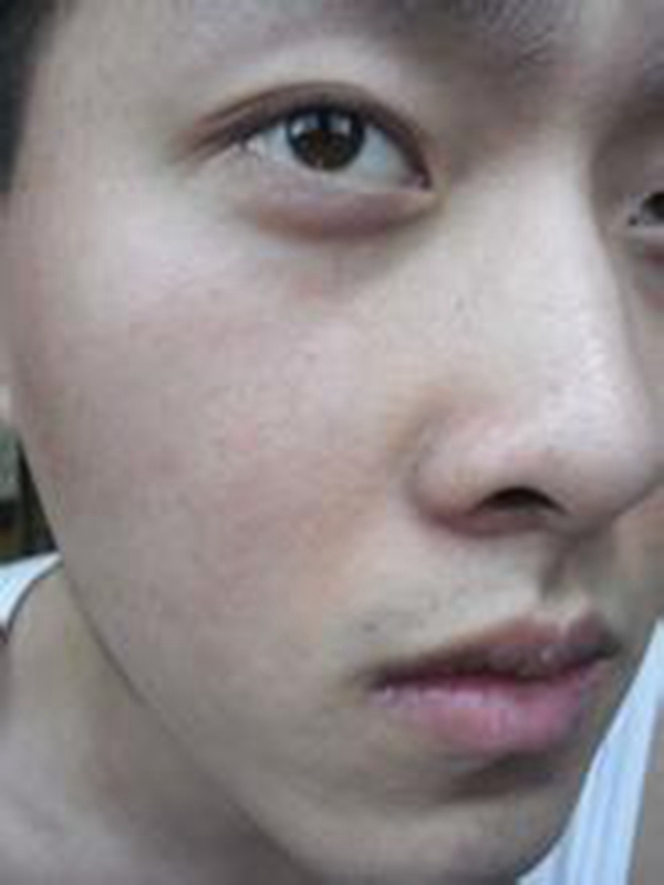 男性脸部脂溢性皮炎患者图片
