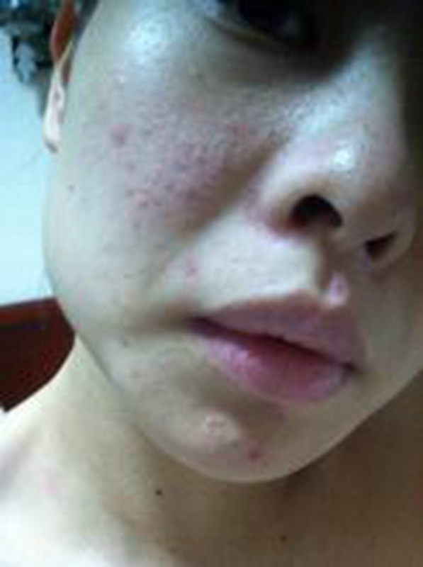 女性脂溢皮炎面部图片图片