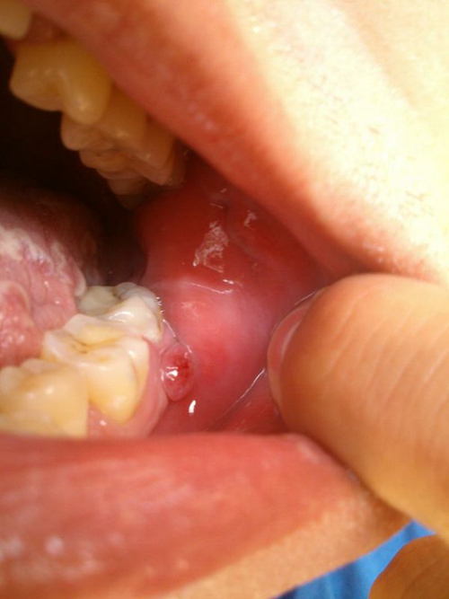 口腔粘膜炎症 淋膜图片