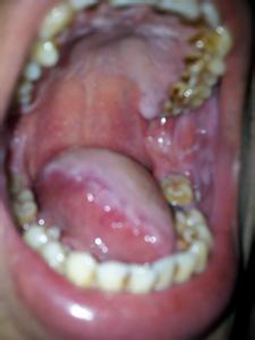 淋巴结口腔发炎牙齿上的图片