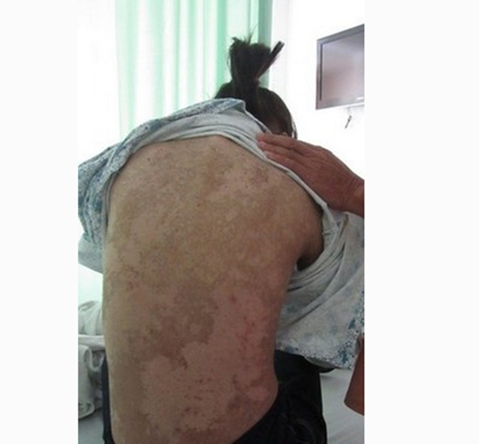 女性背部症状红斑狼疮 图片