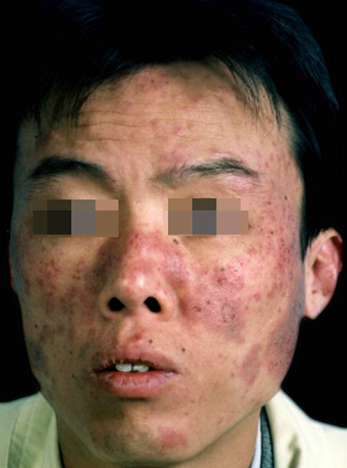红斑狼疮早期脸部图片图片