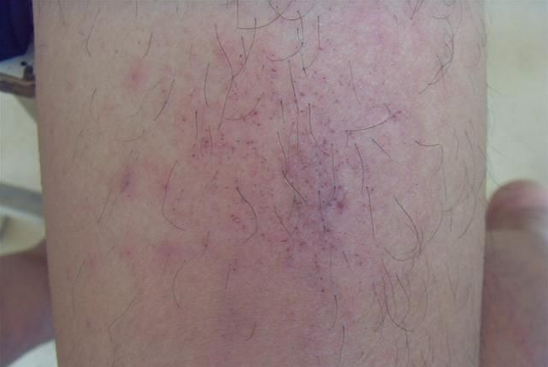 腿部夏季皮炎症状图片