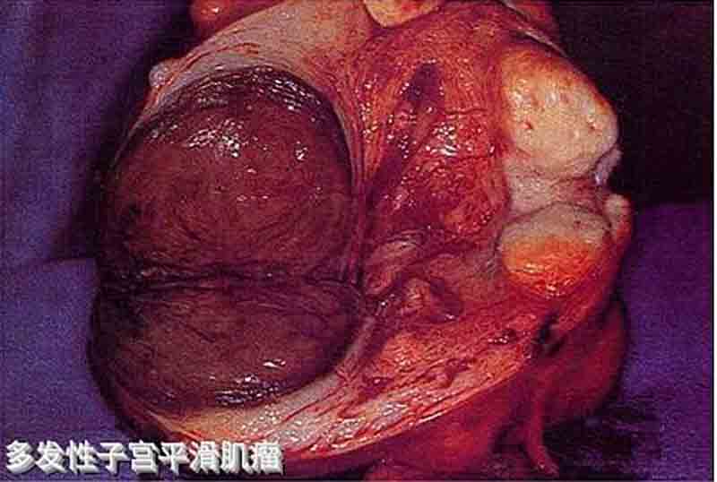 多发性子宫平滑子宫肌瘤图片
