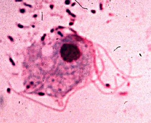 阴道炎霉菌感染图片