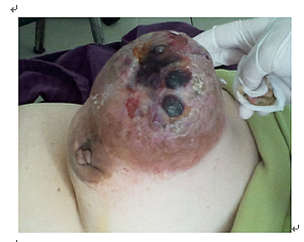 乳腺癌晚期乳房的状况图片