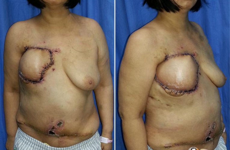 乳腺癌术后胸壁癌性溃疡的治疗图片