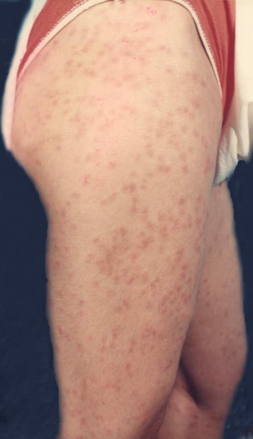 下肢丘疹性二期梅毒疹图片